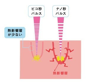 PICOレーザー